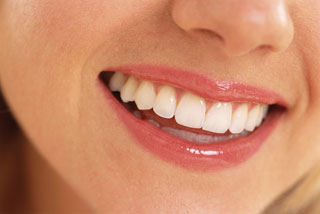 Veneers